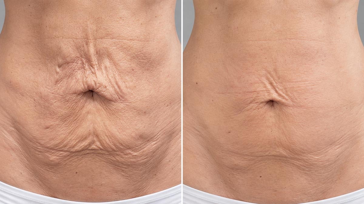 Before and after comparison of abdominal skin appearance following ONDA Coolwaves body contouring and skin tightening treatment